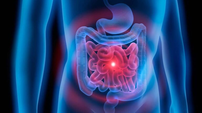 Microbiome in Irritable Bowel Syndrome
